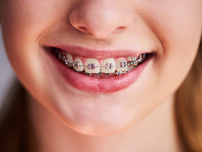 A close-up image of a smiling person with braces, showcasing their straight teeth and pink lipstick.