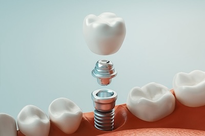 The image shows a close-up of a tooth with an implant screwed into it, set against the background of a dental model with teeth and gums.