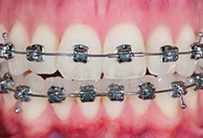 The image shows a close-up of a person s teeth with a metal bracket and wire attached to the upper front teeth, which is commonly used for orthodontic treatment.