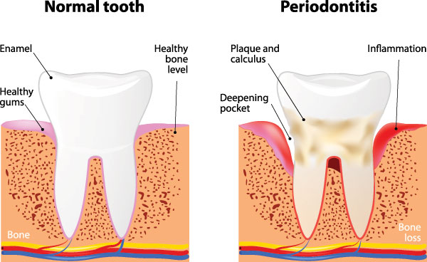 The image is a detailed medical illustration showing the progression of tooth decay from normal to severe stages, including the formation of cavities and the presence of plaque and bacteria.