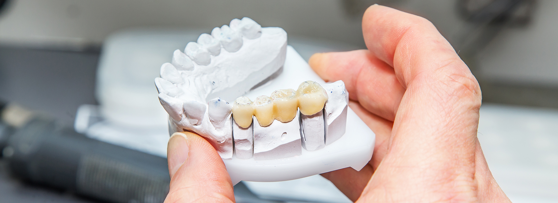 A hand holding a dental implant with teeth and gum details, against a blurred background.