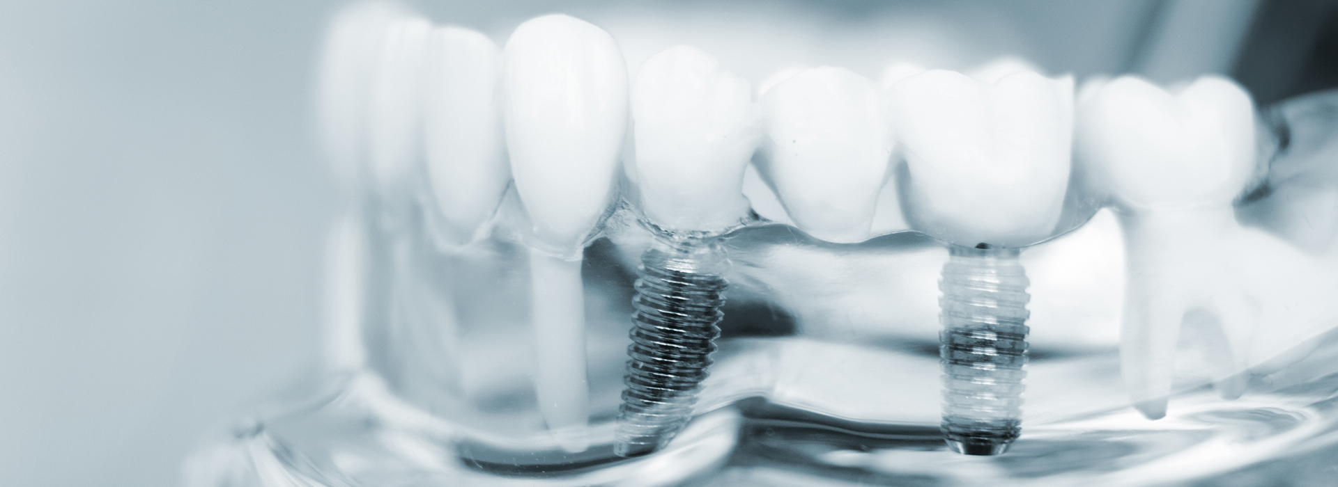 The image shows a close-up of dental implants with screws and abutments, placed on a transparent background.