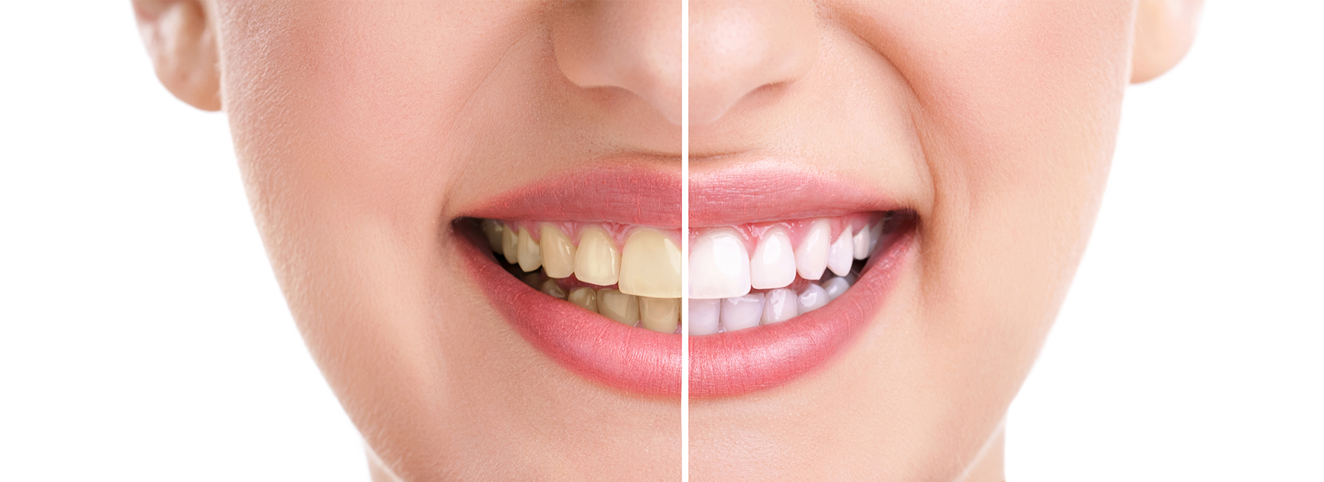 Close-up of a person s face with a smile, showcasing teeth whitening before and after treatment.