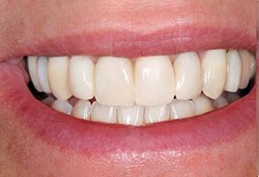 Image of a close-up view of a person s smiling mouth, displaying white teeth and red gums.