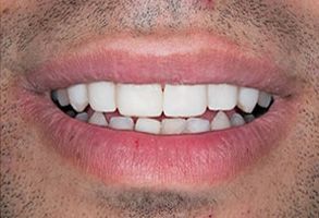 The image shows a close-up of a person s smiling mouth and teeth, with the upper lip partially visible.