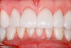 The image displays a close-up view of a person s teeth, showcasing a bright and clean smile with white fillings.