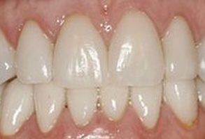 The image shows a close-up of a person s teeth with a focus on the dental work, specifically the yellowing and staining around the edges.