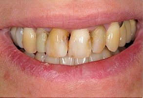 The image shows a close-up of an individual s smile, revealing yellowing and staining on the teeth, which is indicative of dental issues such as tooth decay or discoloration.