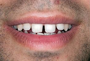 Smiling man with a missing tooth, showcasing dental implant advertisement.