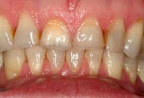 The image shows a close-up of a person s teeth with visible signs of dental decay and discoloration.